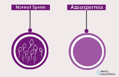 Normal Sperm Vs Azoospermia