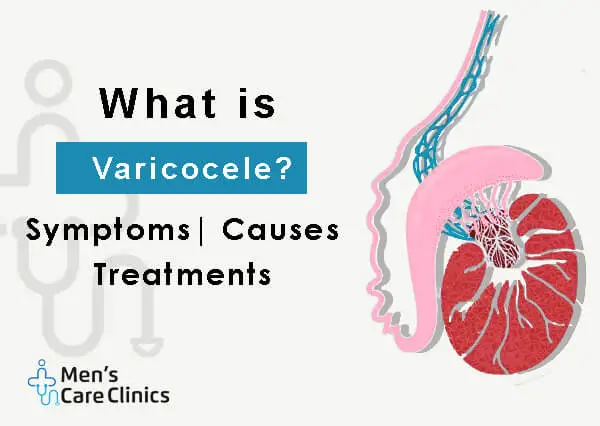 Varicocele, Symptoms, Causes and Treatment.