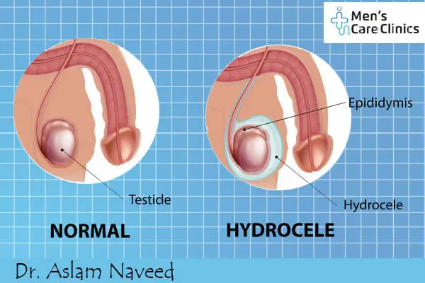 Hydrocele, Causes, Symptoms and Treatments