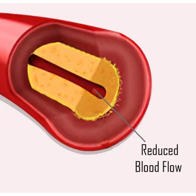 Reduced blood flow